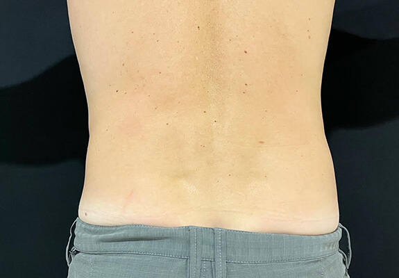 Back Lift (Bra Line Back Lift) Before and After Pictures Case 1097